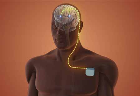 Emerging Opportunities in Nervous System Regulation Devices